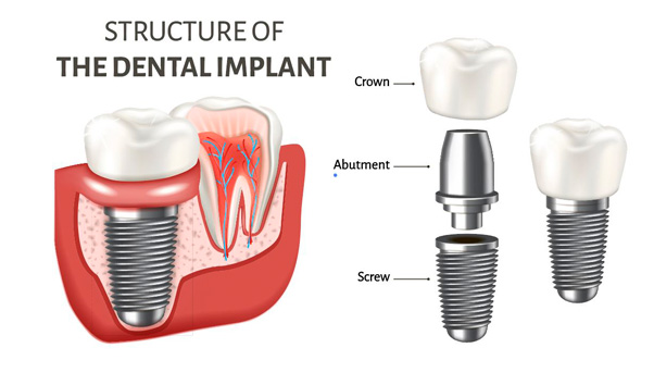 structure of the dental implant