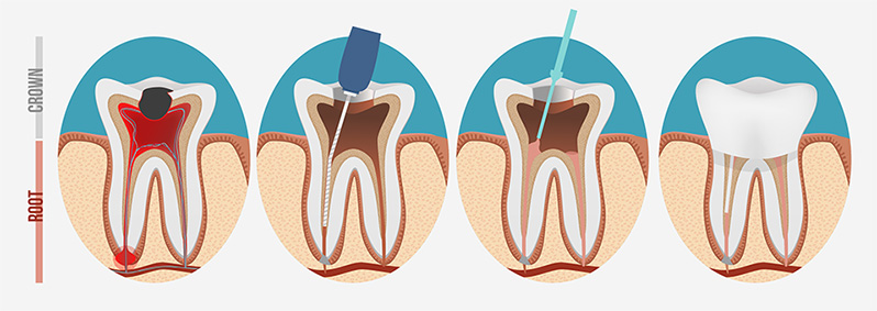 root canals lehigh valley