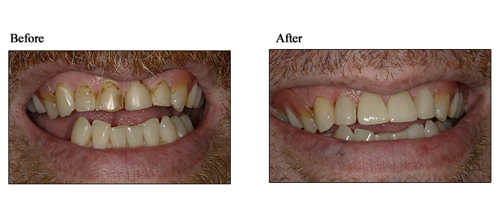 lehigh valley teeth whitening