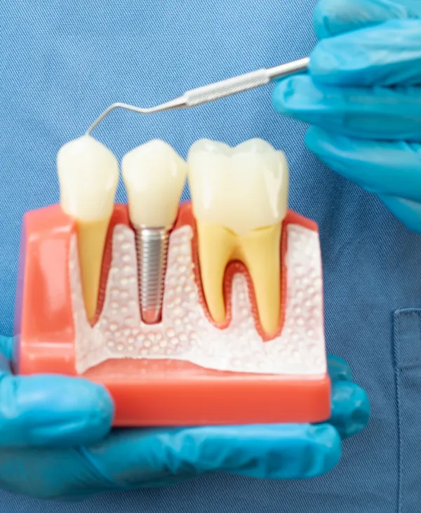 Dental Implants