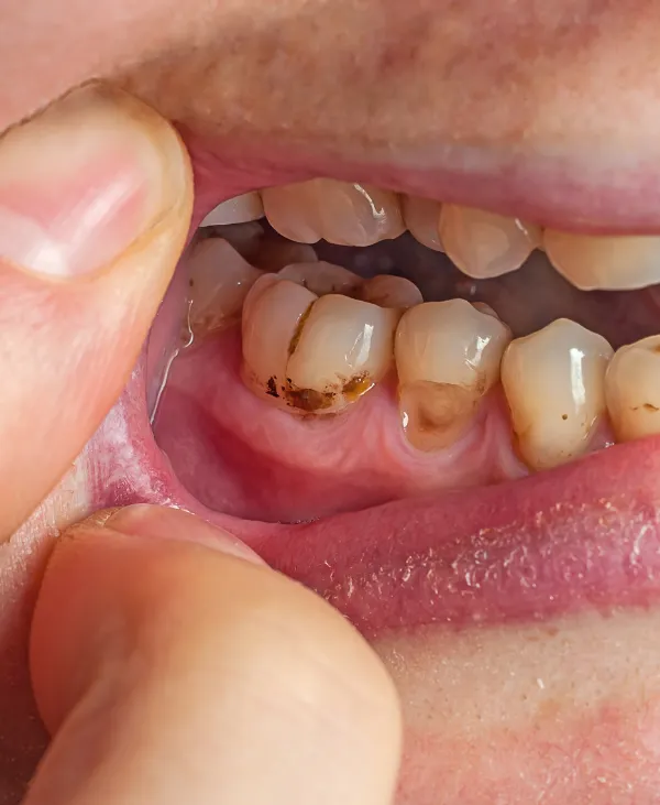Sedation Dentistry