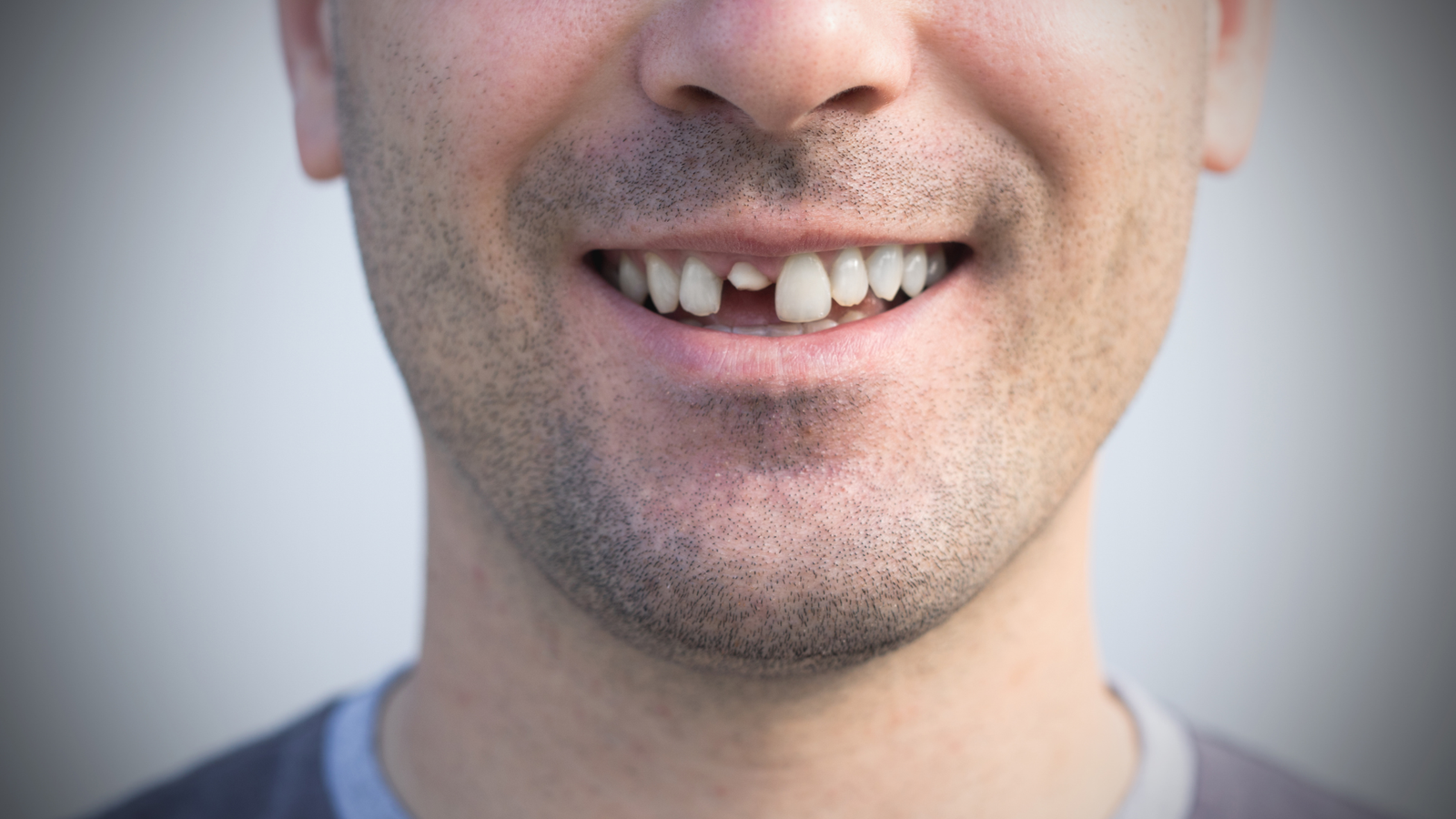 Broken or Cracked Tooth: When Is It a Dental Emergency?