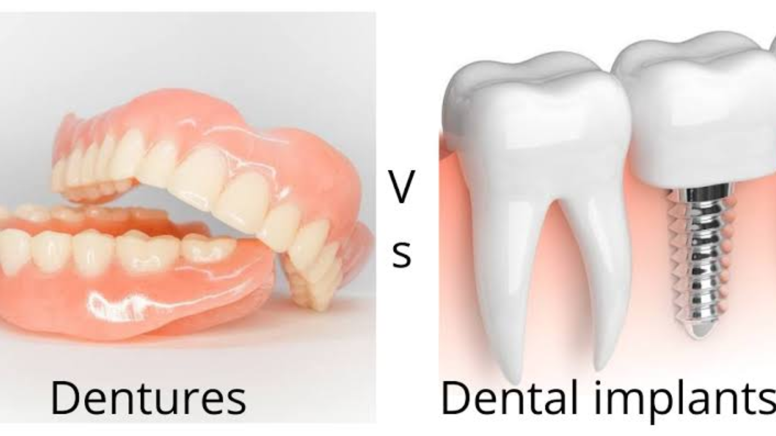 Dental Implants vs. Dentures Which Is Right for You